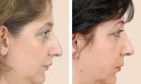رأب الأنف (Rhinoplasty)